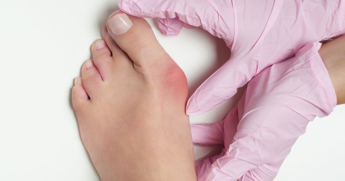 Κότσι στο πόδι (Hallux Valgus) - Αιτίες, συμπτώματα και προϊόντα περιποίησης ποδιών για ανακούφιση